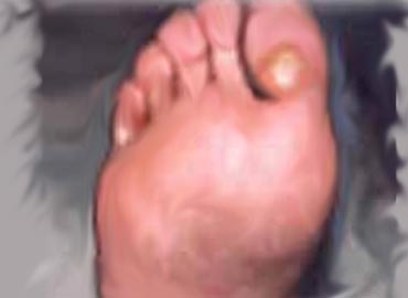 El hongo sobre la cabeza del miembro que curar